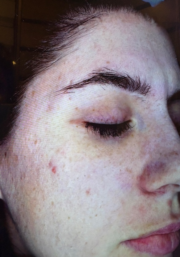Microneedling — after treatment