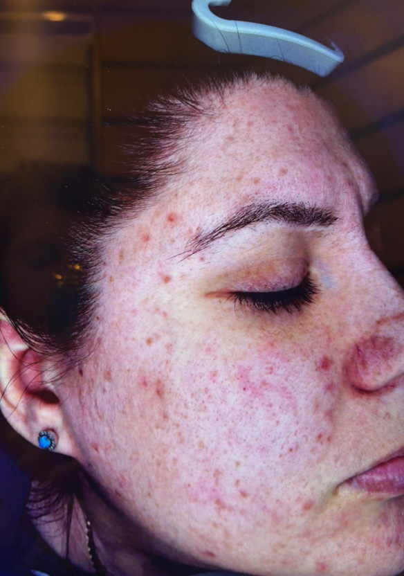 Microneedling — before treatment