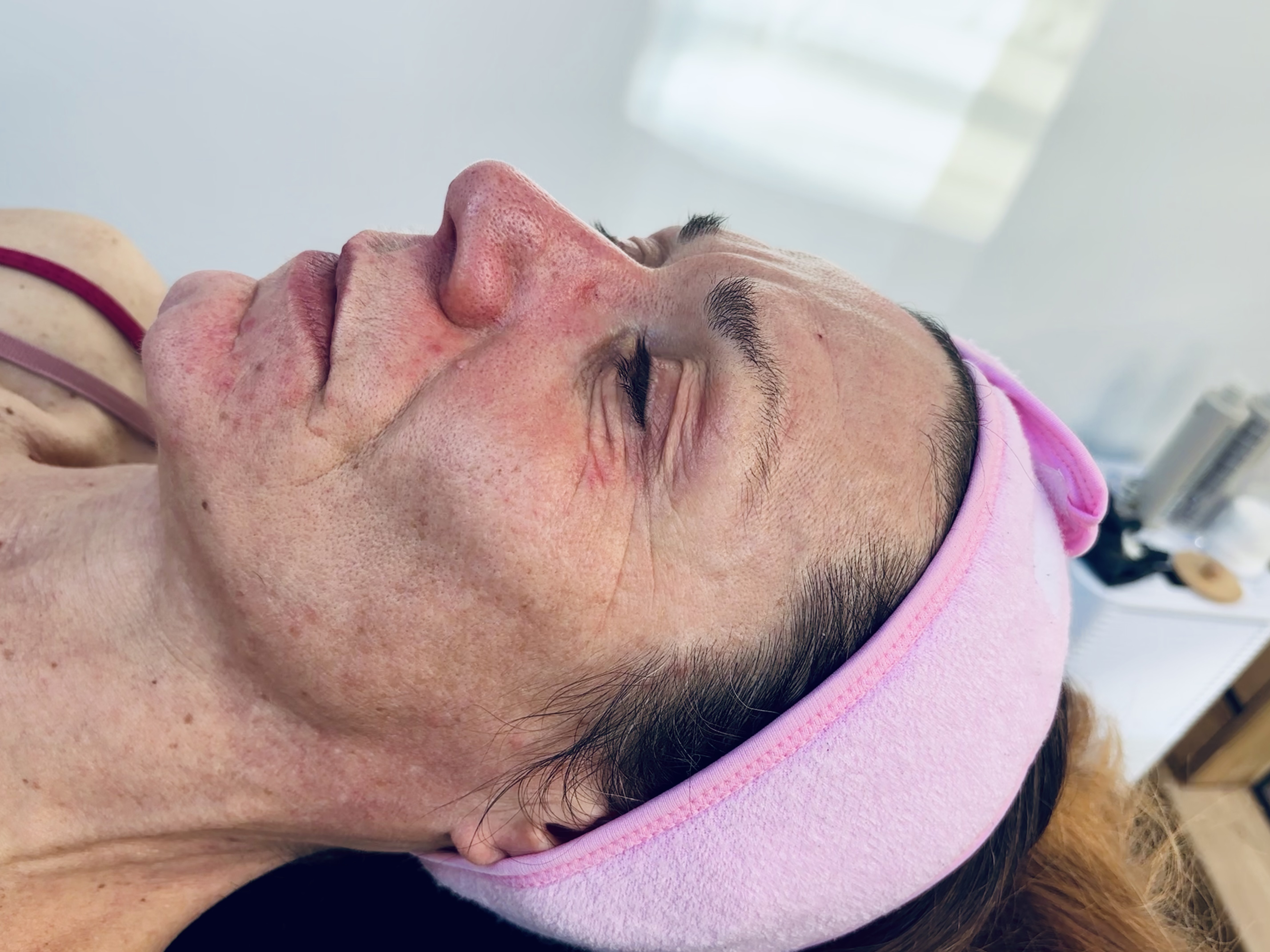 Peel — before treatment