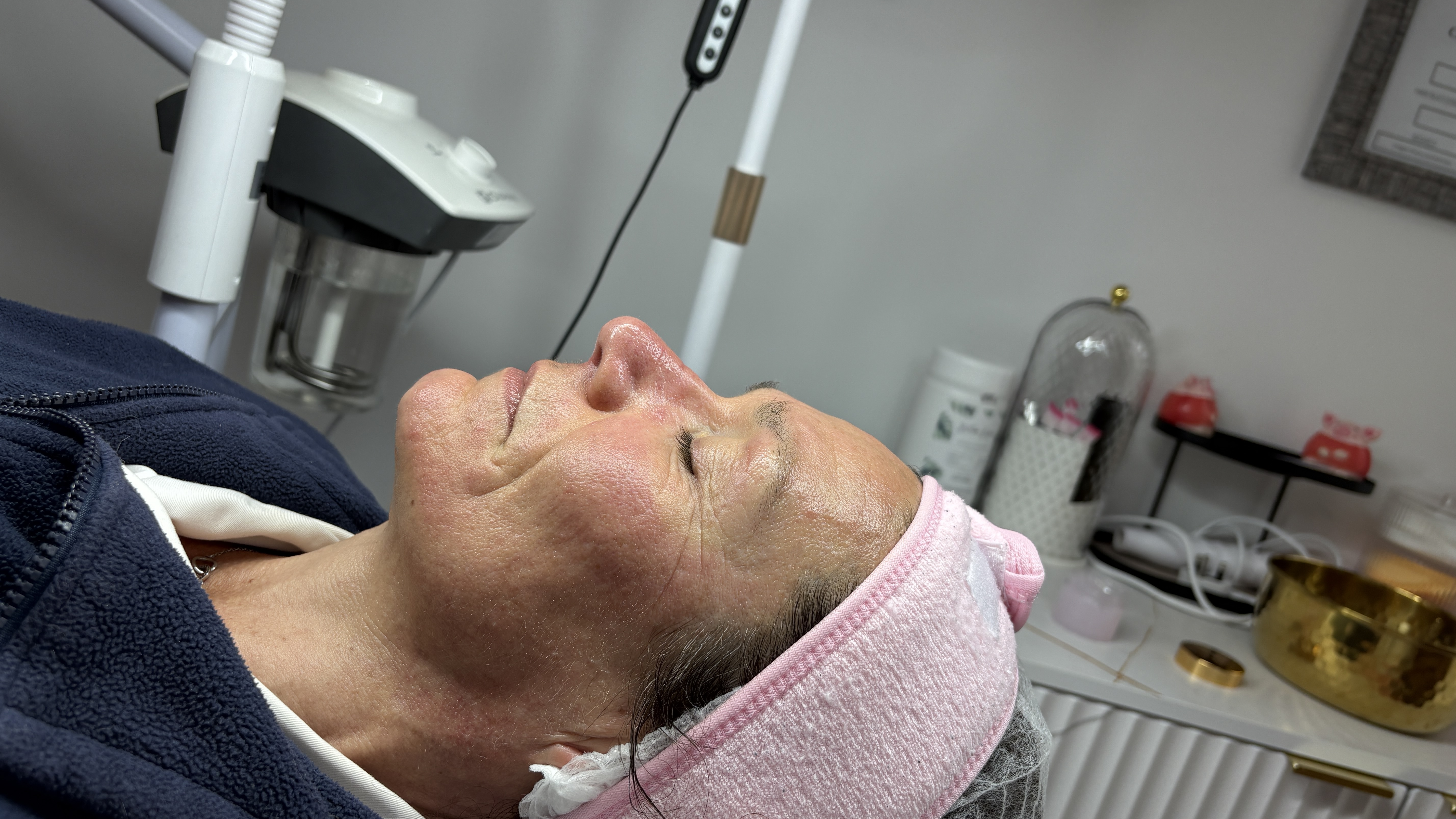 Peel — after treatment